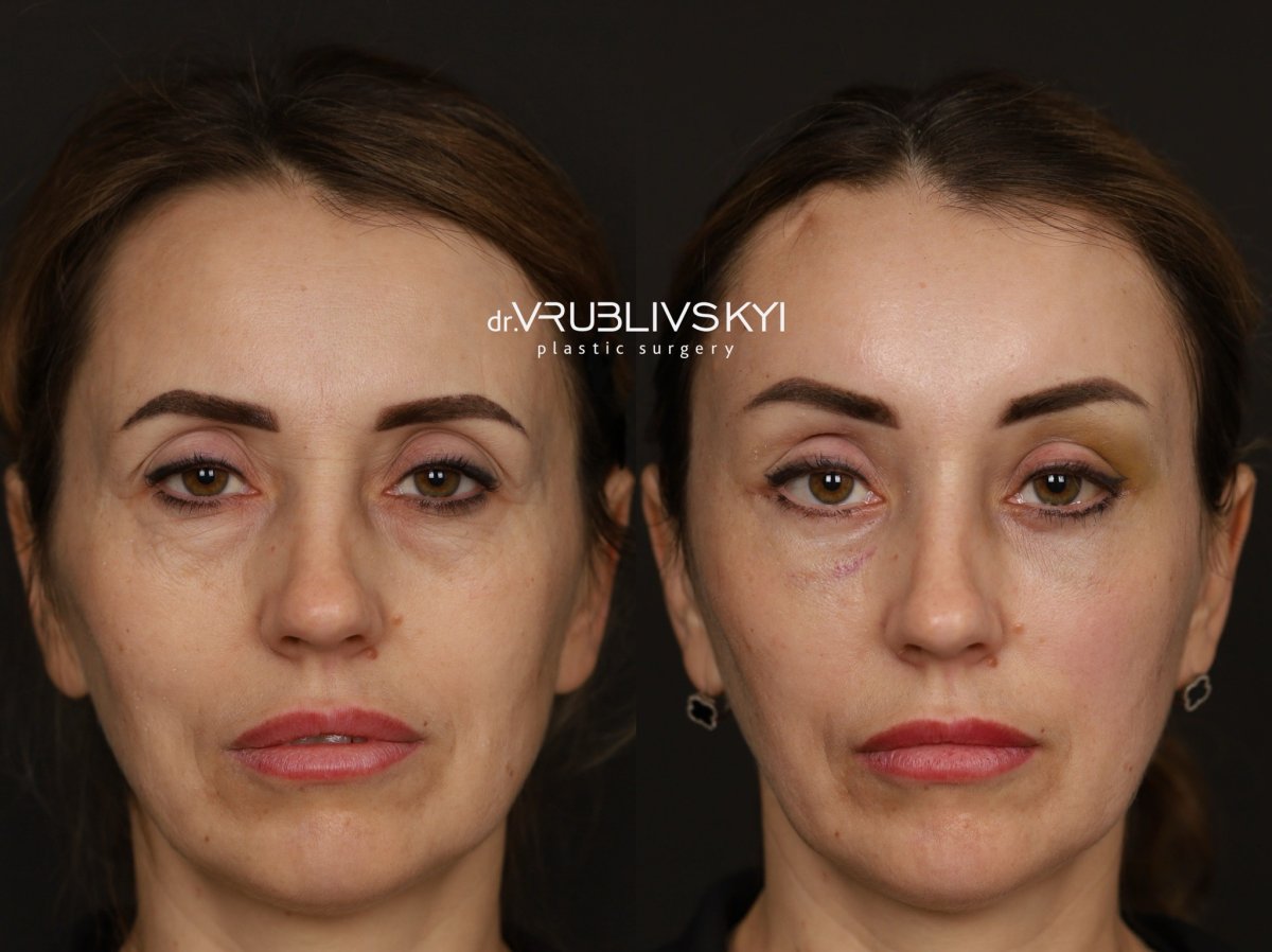نتائج شد الوجه قبل وبعد في Dr. VRUBLIVSKYI Plastic Surgery، تجديد شباب الوجه