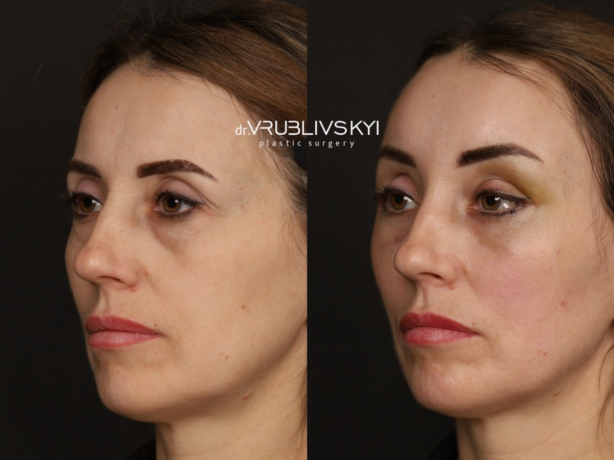 Facelift before and after results at Dr. VRUBLIVSKYI Plastic Surgery, facial rejuvenation