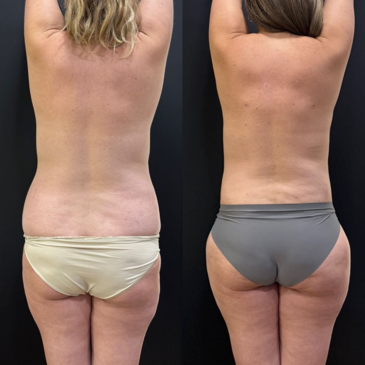 Résultats avant/après mommy makeover – taille et silhouette du corps améliorées