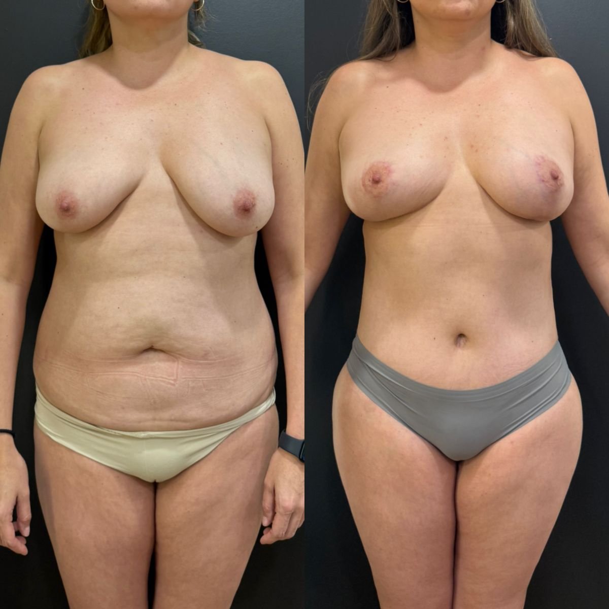Resultados antes y después de mommy makeover – mejora visible del contorno corporal y mamario