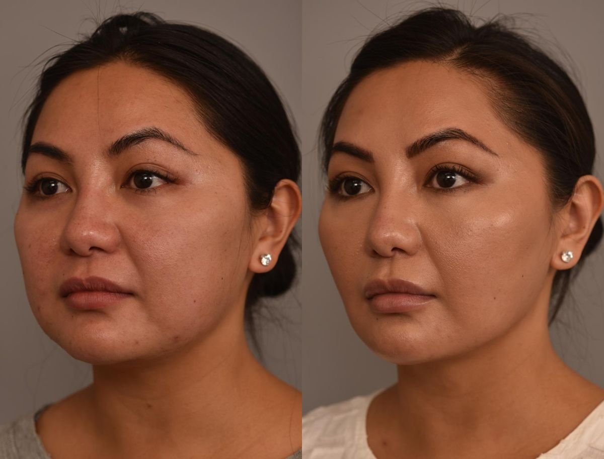 Before and after buccal fat extraction results – slimmer cheeks and enhanced facial contour