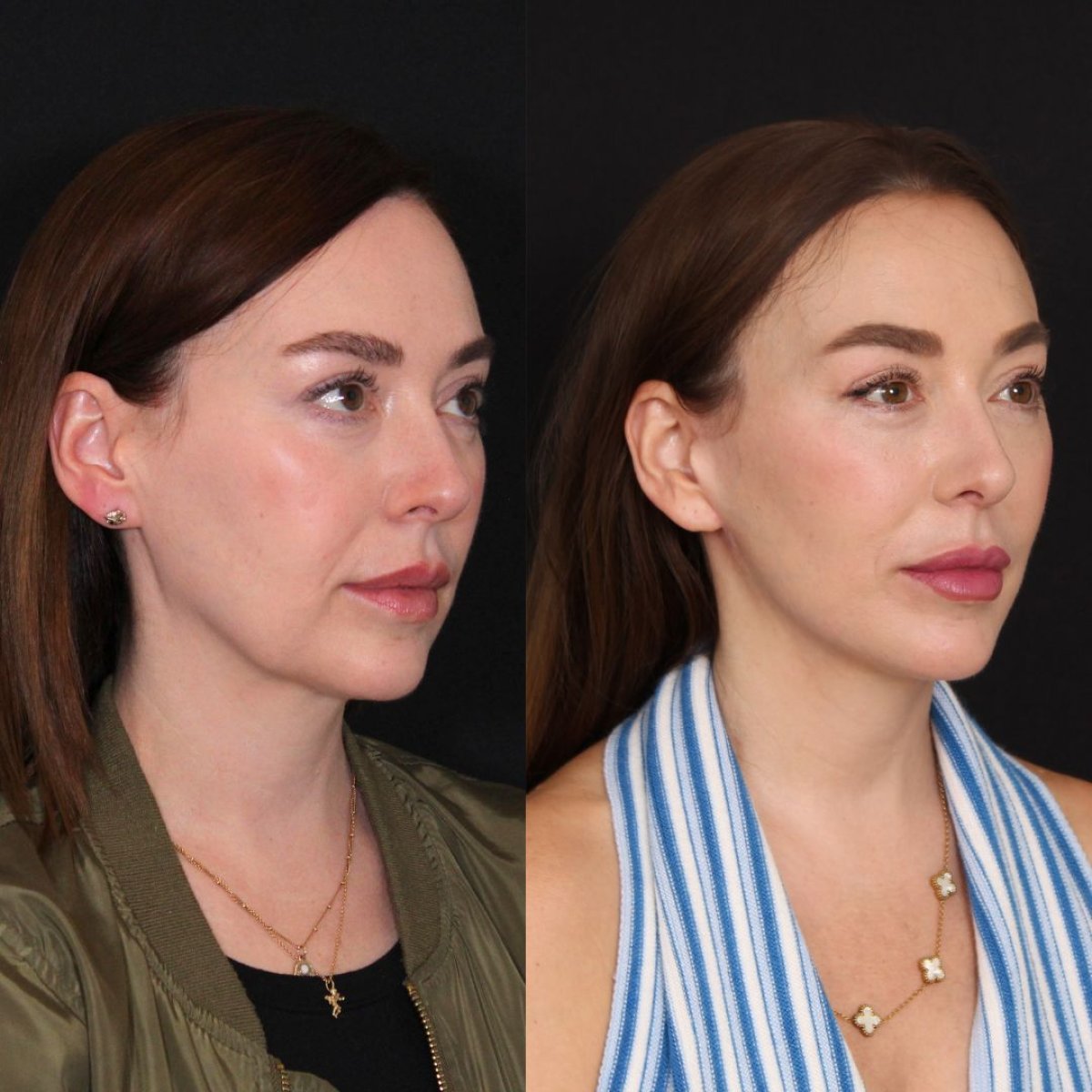 Resultados antes y después de extracción de bolas de Bichat: mejillas más delgadas y contorno facial