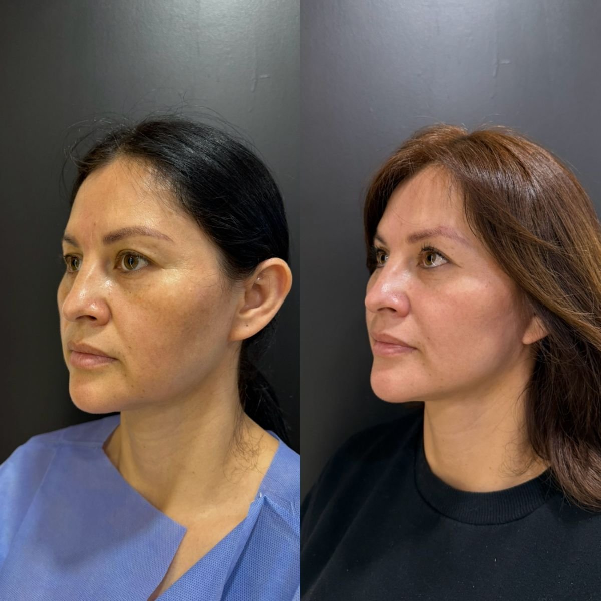 Resultados de blefaroplastia superior e inferior antes y después, rejuvenecimiento ocular