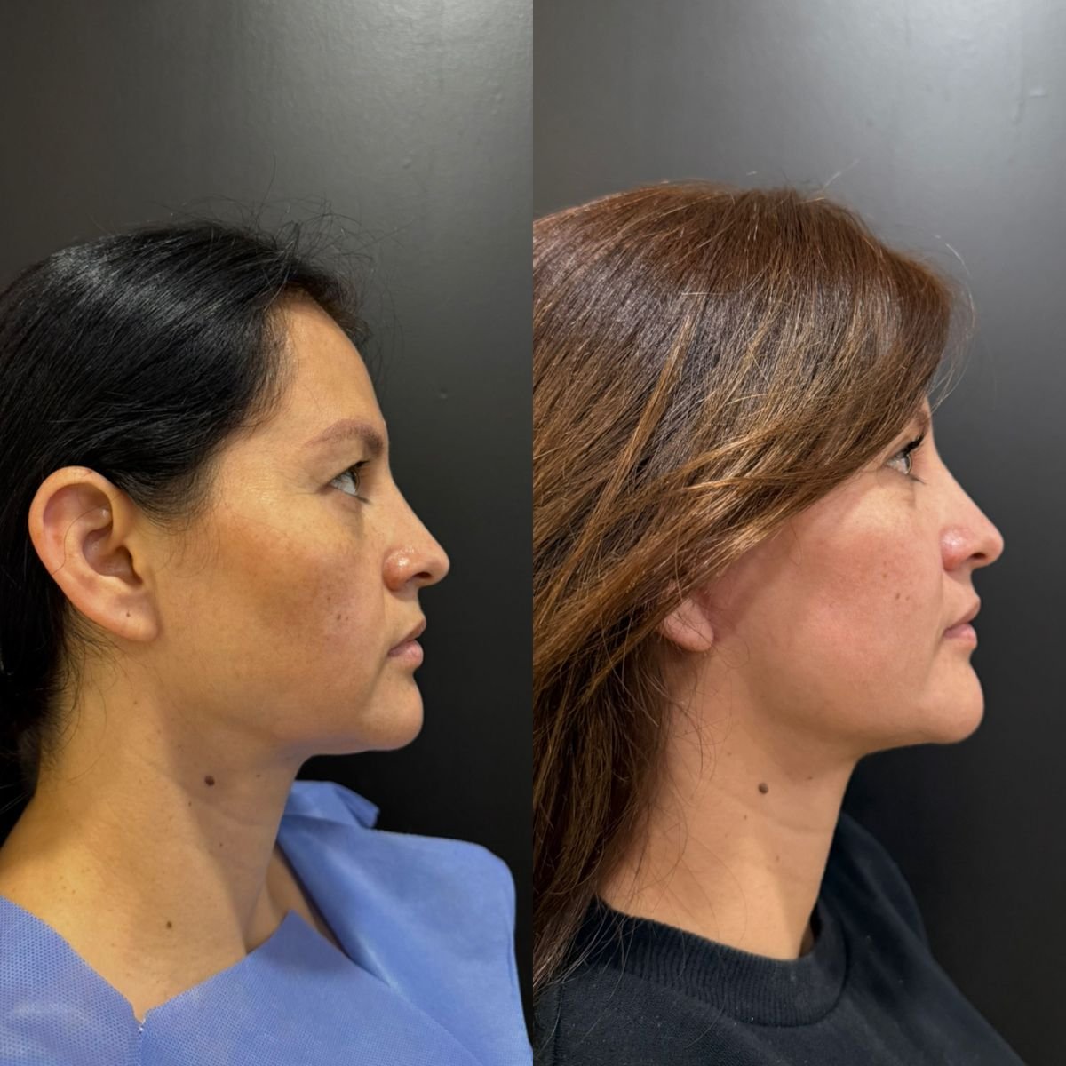 Resultados de blefaroplastia superior e inferior antes y después – rejuvenecimiento ocular