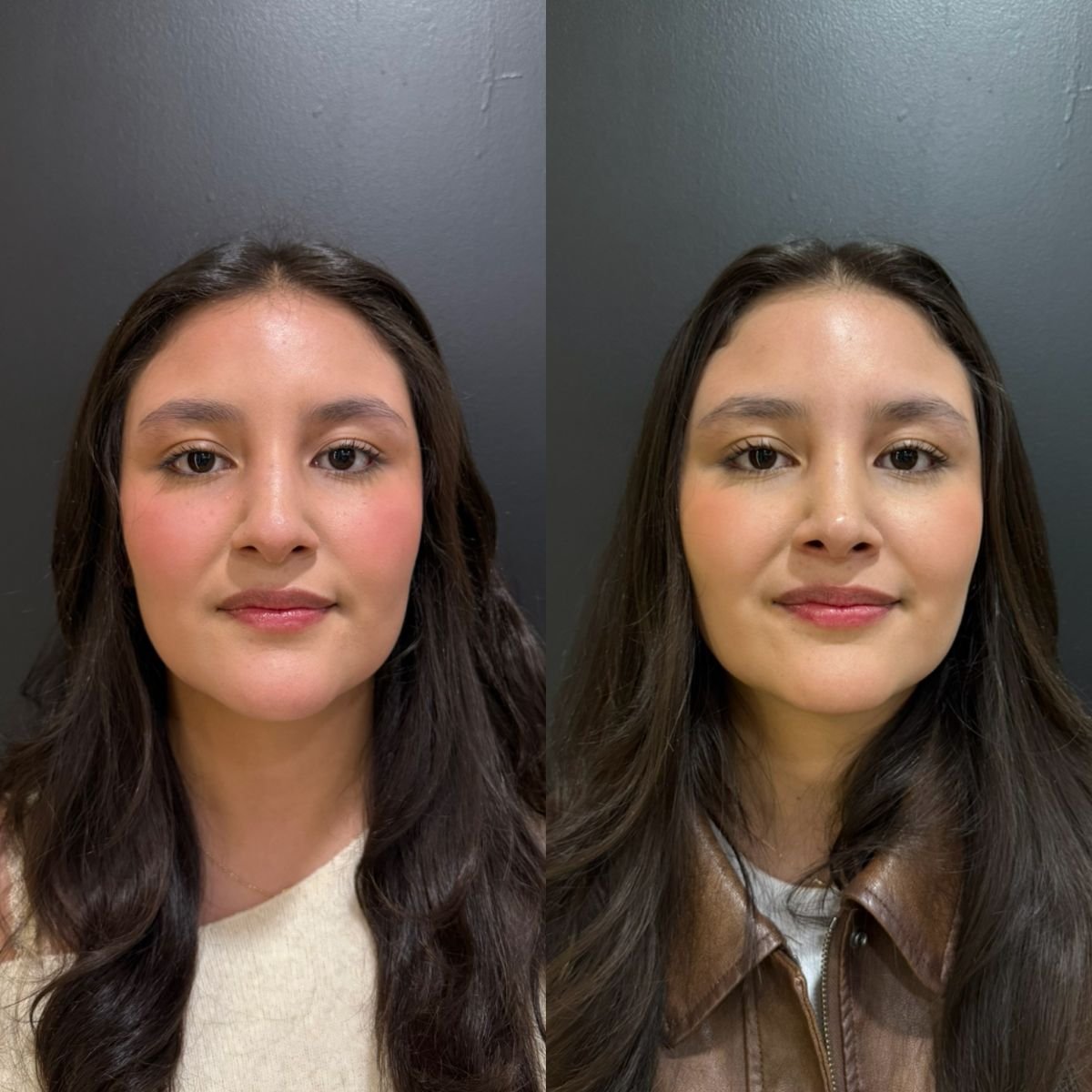 Resultados de rinoplastia antes y después, remodelación nasal natural en la clínica