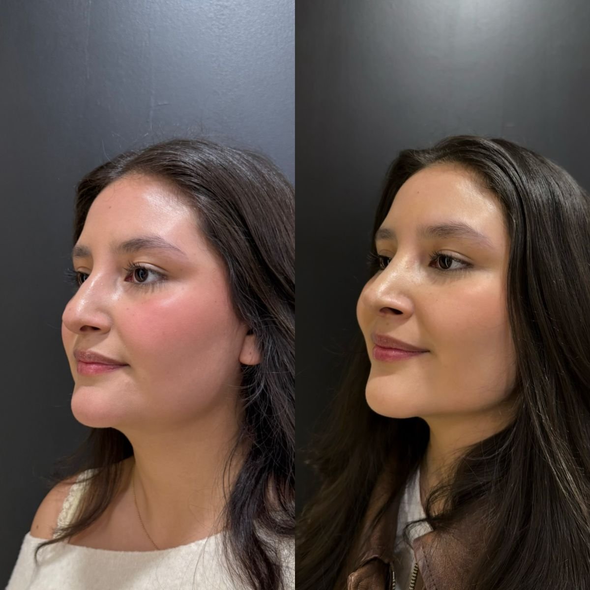 Resultados de rinoplastia antes y después, mejora natural del perfil nasal