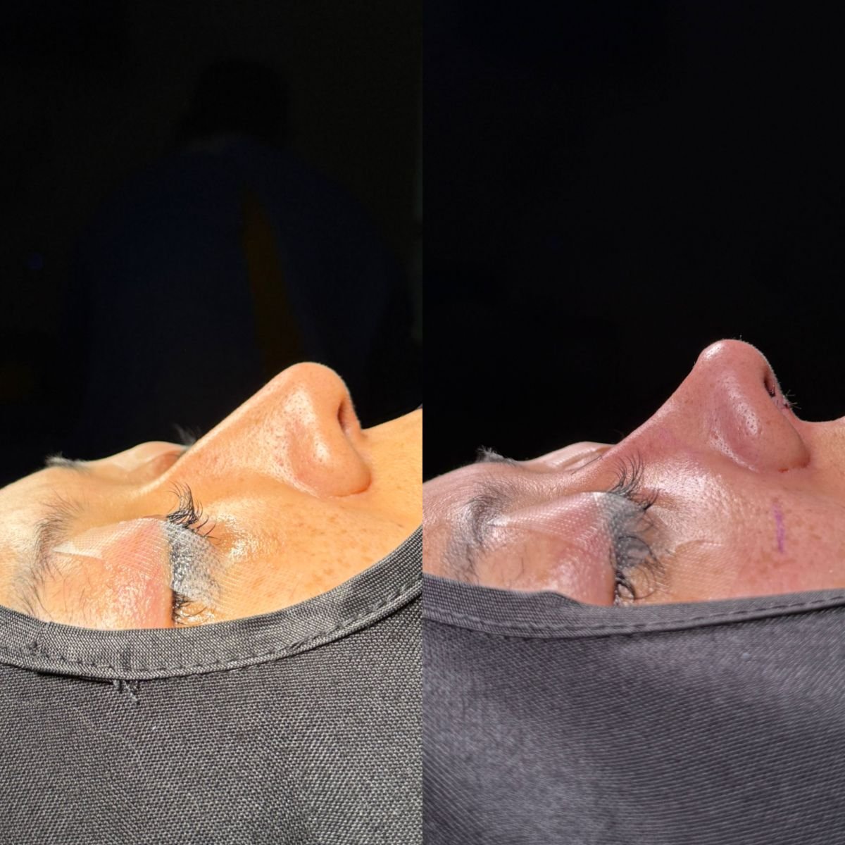 Resultados de rinoplastia antes y después, perfil y contorno nasal mejorados