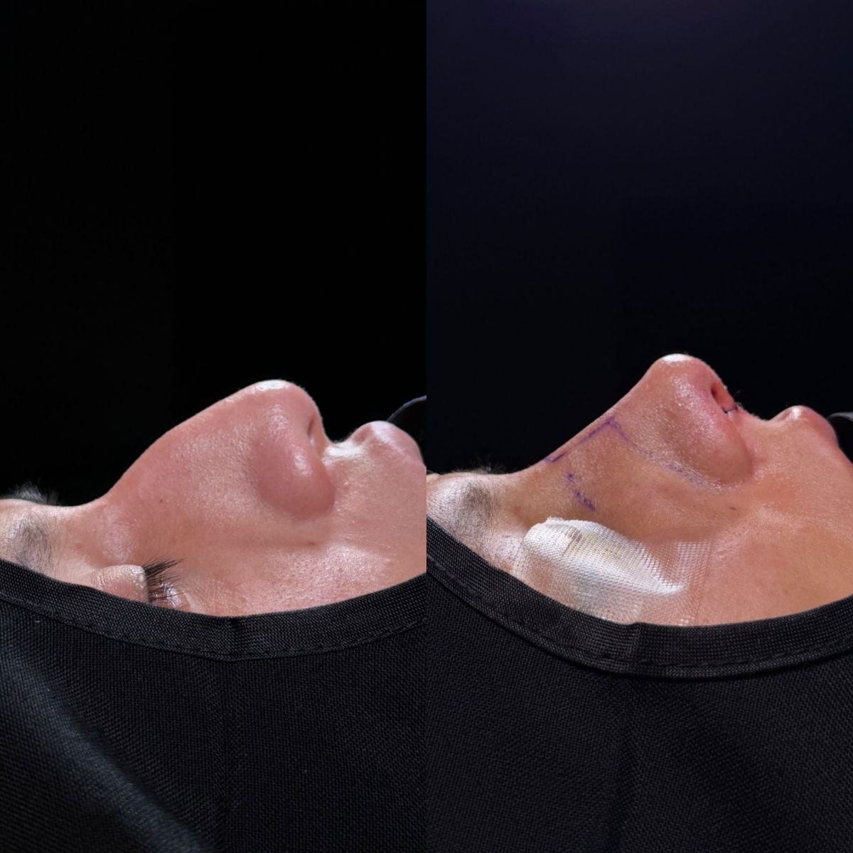 Resultados de rinoplastia antes y después, mejora del perfil nasal en la clínica