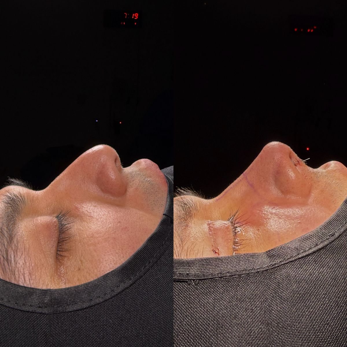 Resultados de rinoplastia antes y después, remodelación nasal masculina con mejor perfil