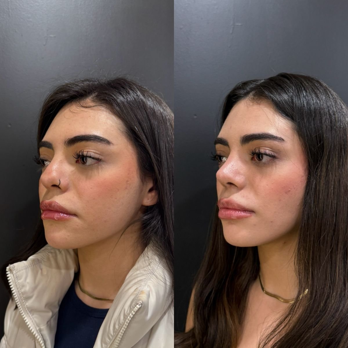 Resultados de rinoplastia antes y después, remodelación nasal natural en la clínica