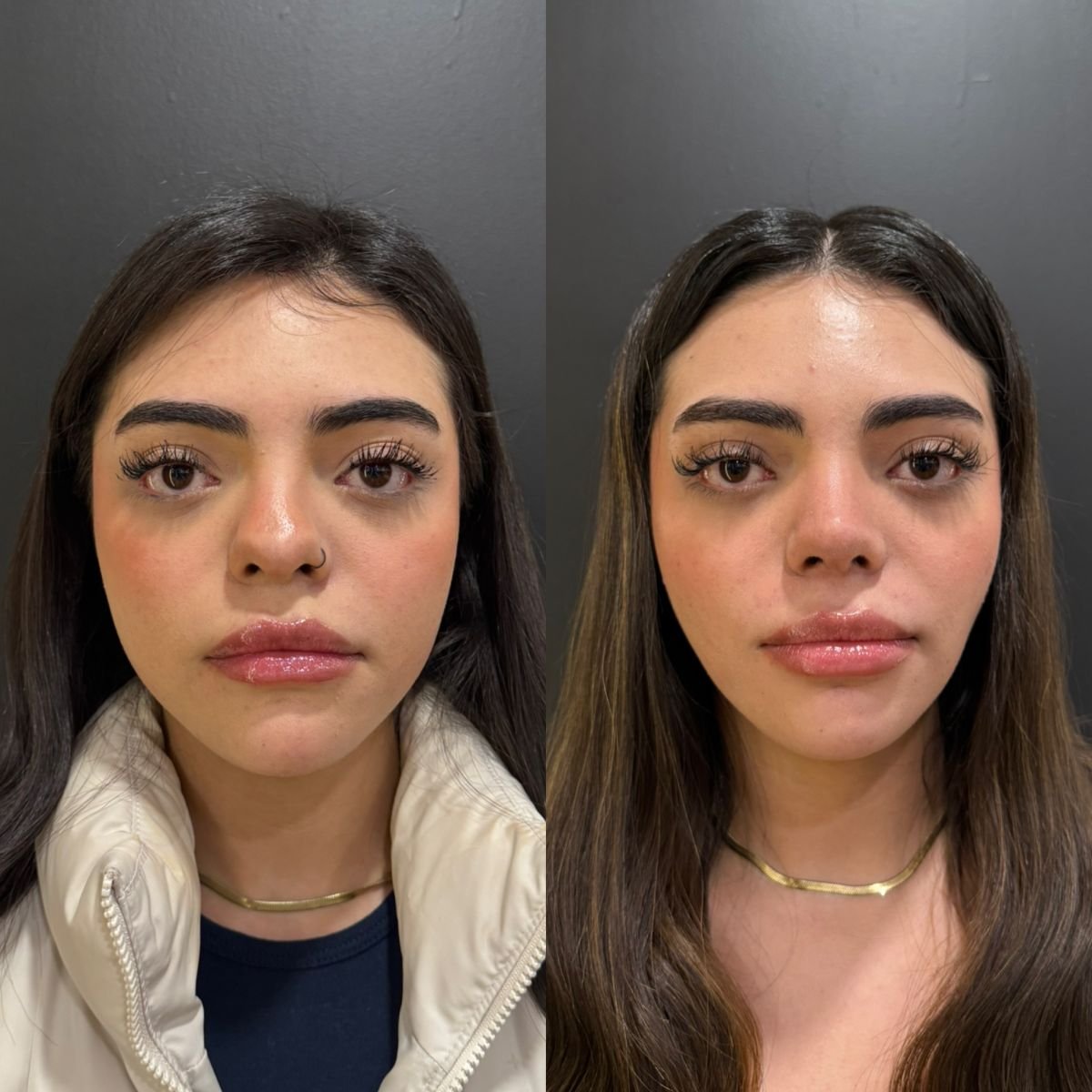 Résultats avant/après rhinoplastie, remodelage naturel du nez à la clinique