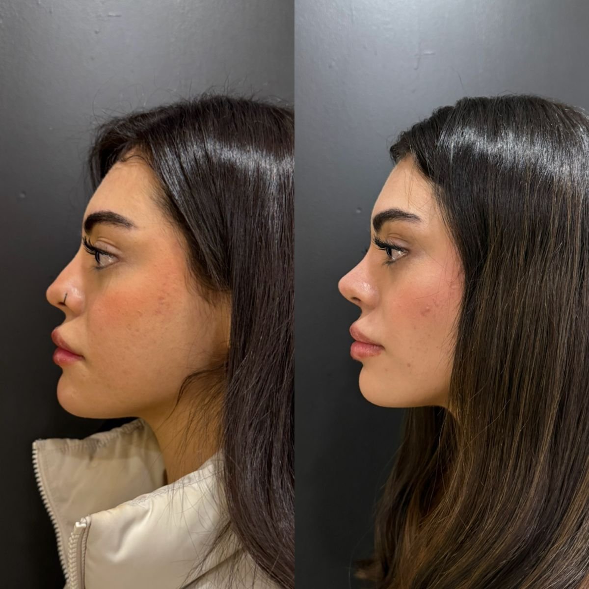 نتائج تجميل الأنف قبل وبعد، تحسين شكل الأنف وتناسقه بعد الجراحة
