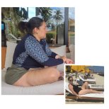 Before and after Roux-en-Y Gastric Bypass photos by Dr. 