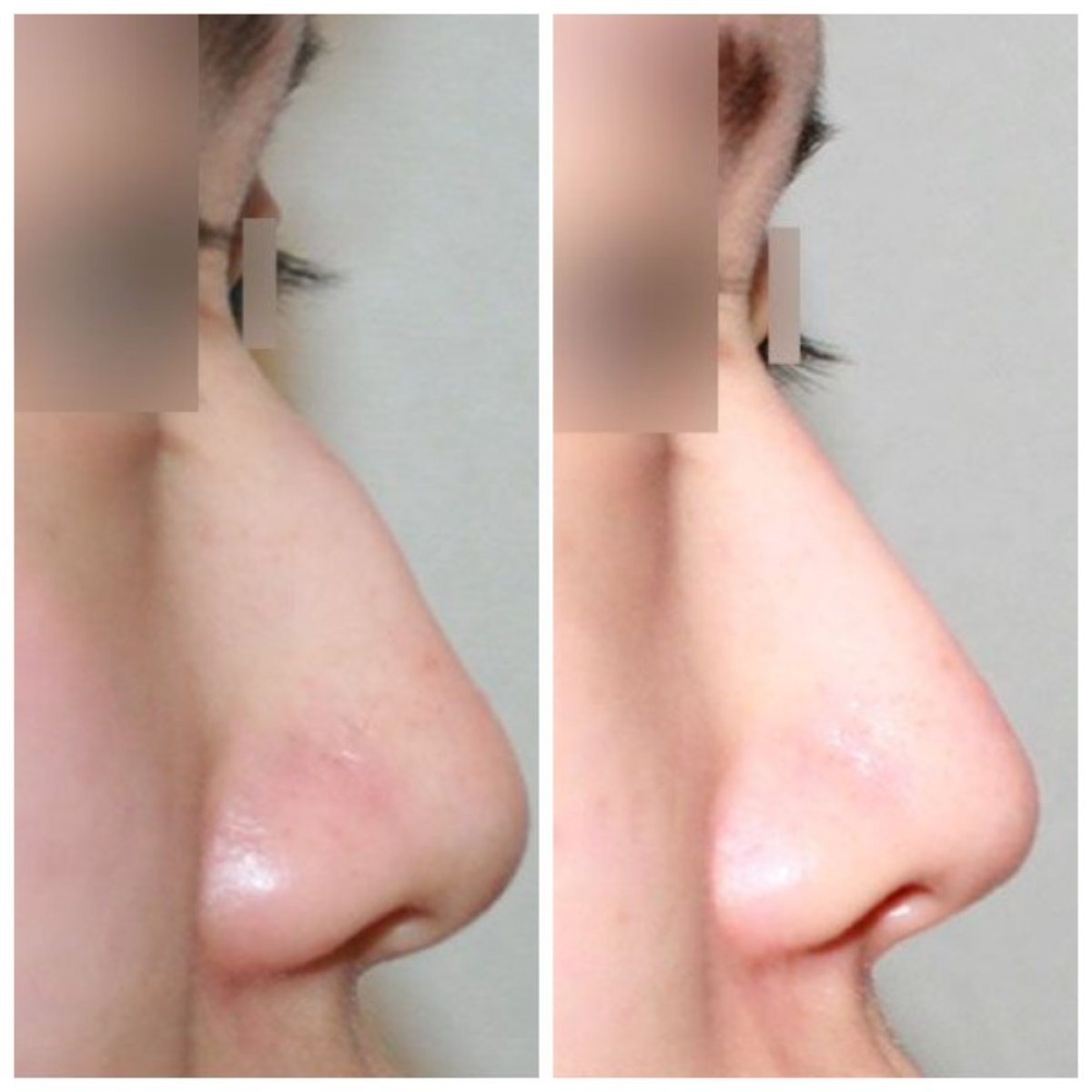 Before and after rhinoplasty results at HERSHE Plastic Surgery Korea, improved nose profile