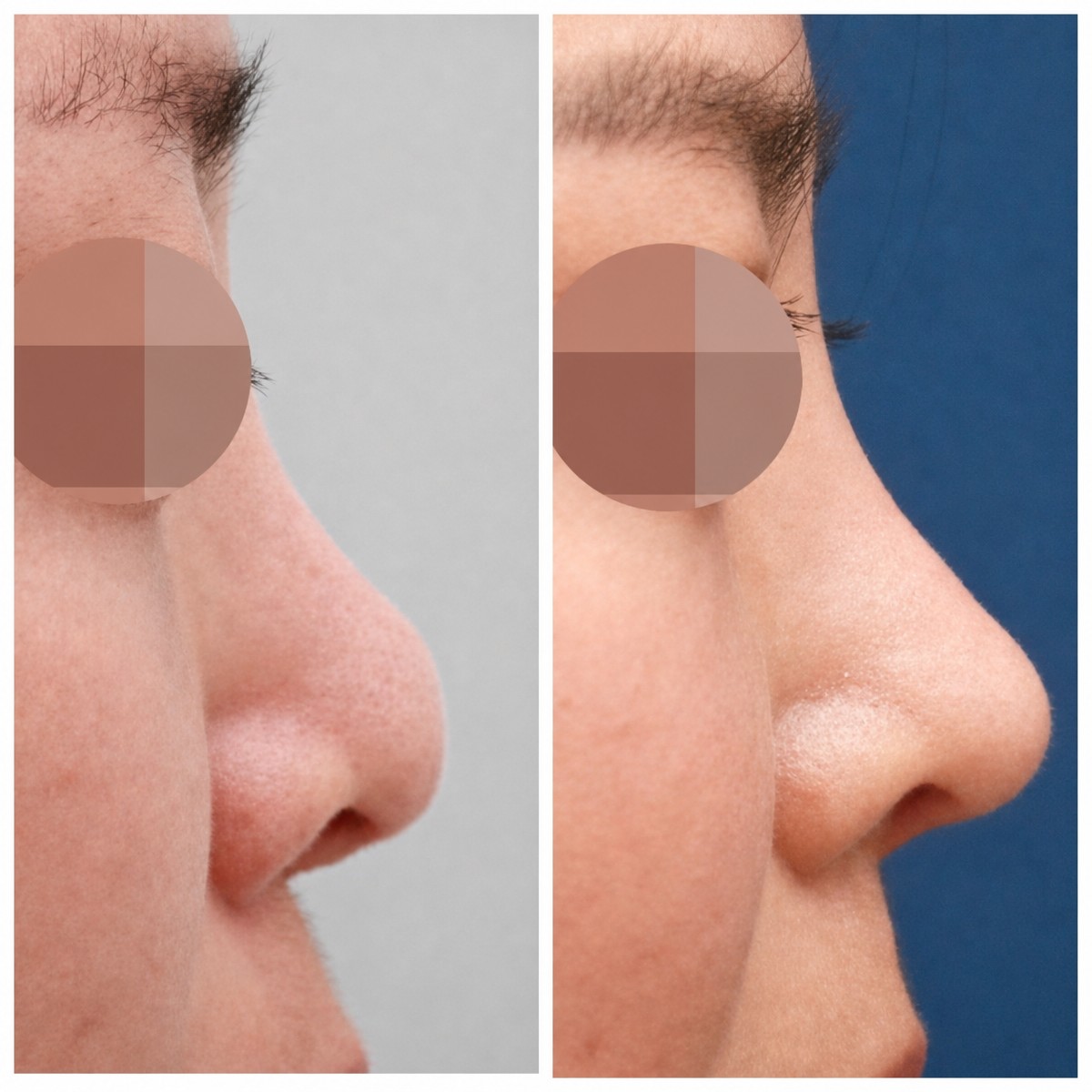 نتائج تجميل الأنف قبل وبعد في HERSHE Plastic Surgery Korea، تحسين شكل الأنف