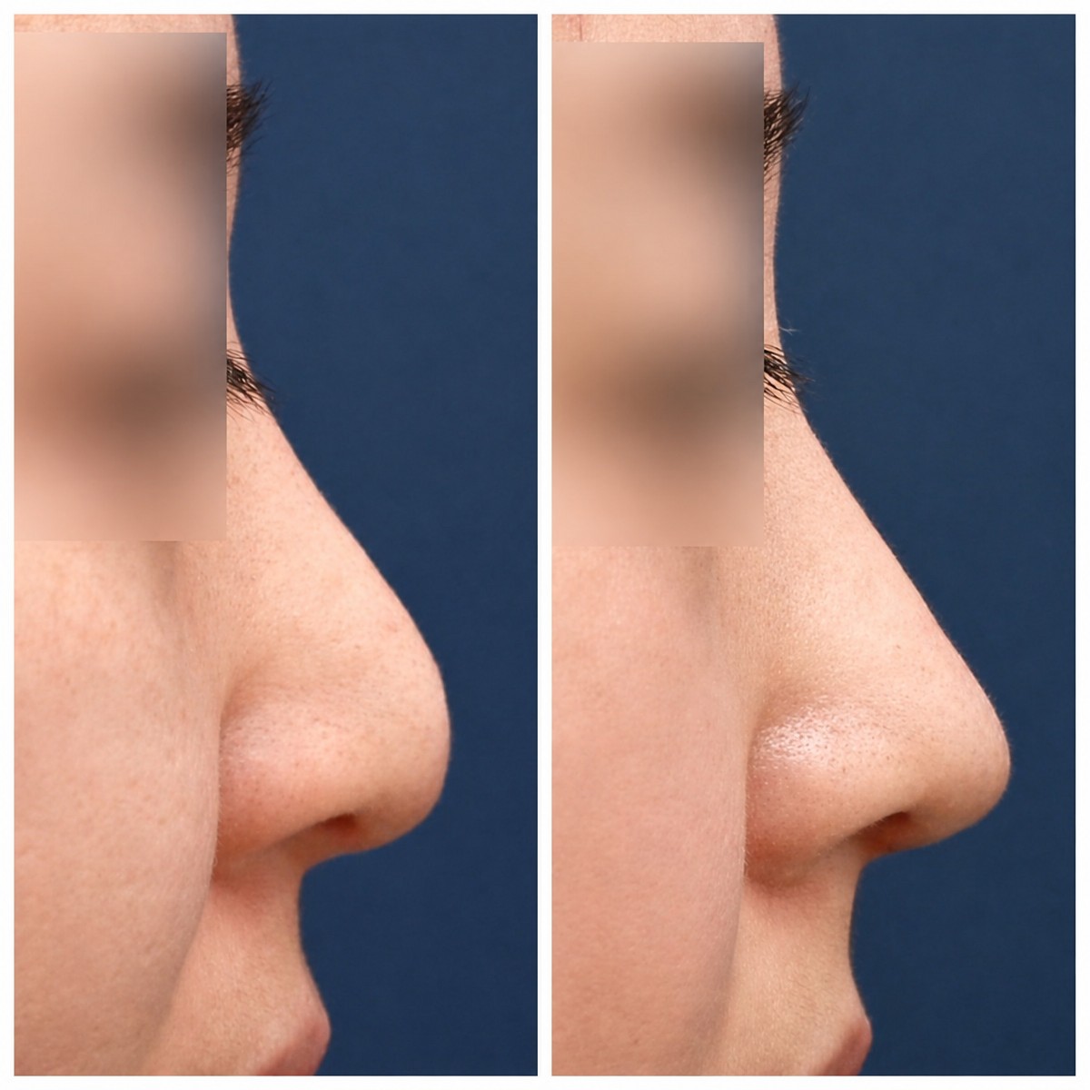 Resultados de rinoplastia antes y después en HERSHE Plastic Surgery Korea, perfil mejorado