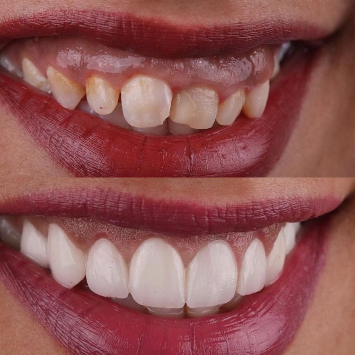 Resultados antes y después de Hollywood Smile en Estemarley – carillas dentales perfectas