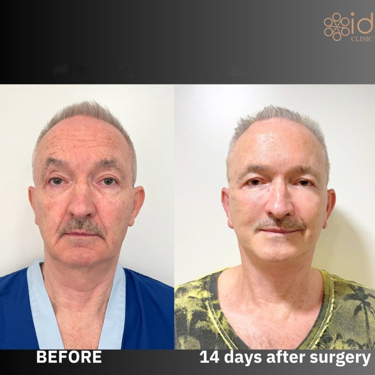 Facelift before and after results at ID Clinic Bangkok, visible facial rejuvenation in 14 days
