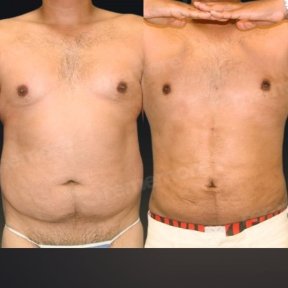 360 liposuction - photo 4