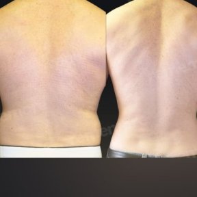 360 liposuction - photo 5