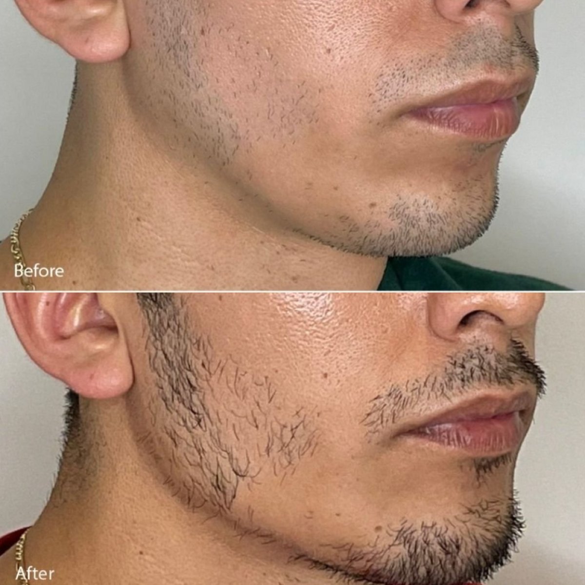 Результаты пересадки бороды до и после в TIAM Aesthetic Clinic, улучшенный рост волос