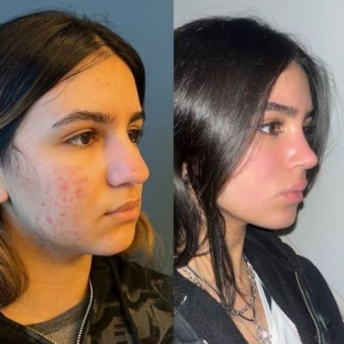 Antes y después de extracción de grasa bucal en CE International Hospital, rostro más delgado