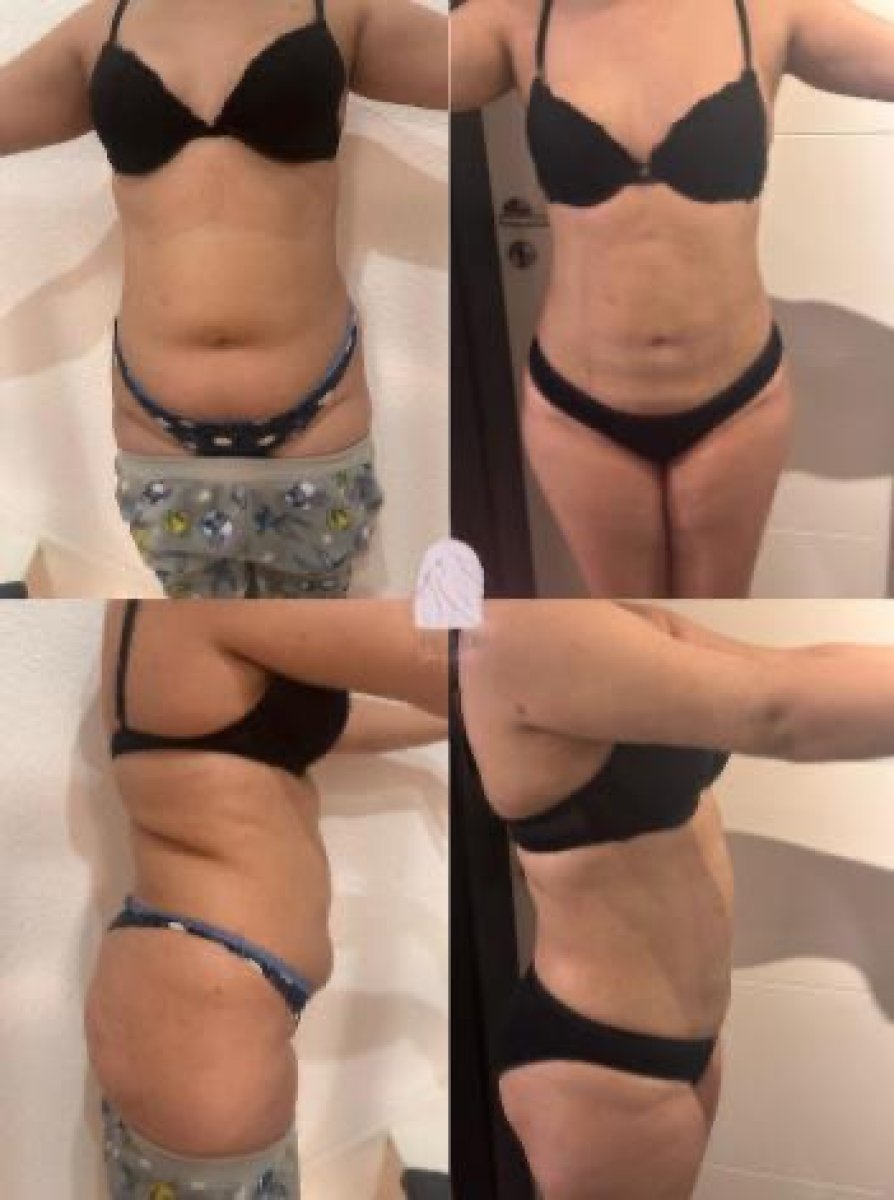 نتائج شفط دهون البطن قبل وبعد في Dr. MED – تحسين واضح لمحيط الخصر