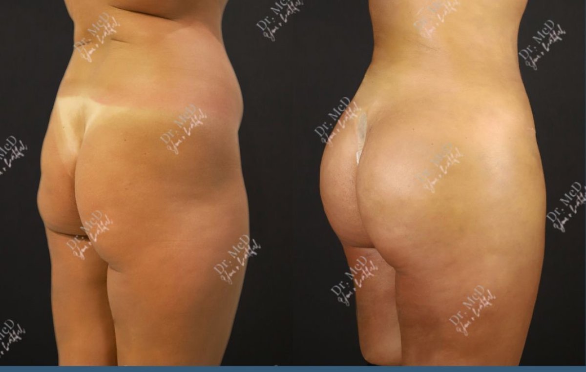 Resultados antes y después de Brazilian Butt Lift en Dr. MED – mayor forma y volumen de glúteos