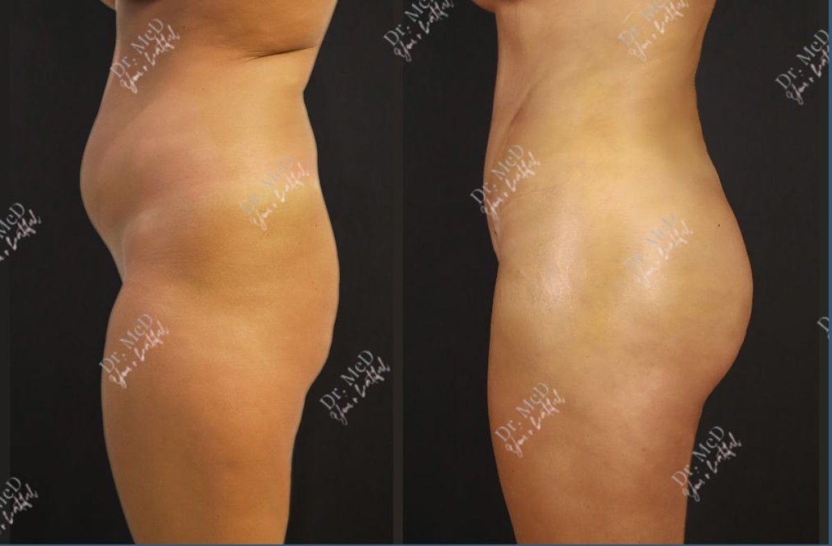 Before and after Brazilian Butt Lift results at Dr. MED – enhanced curves and lifted buttocks