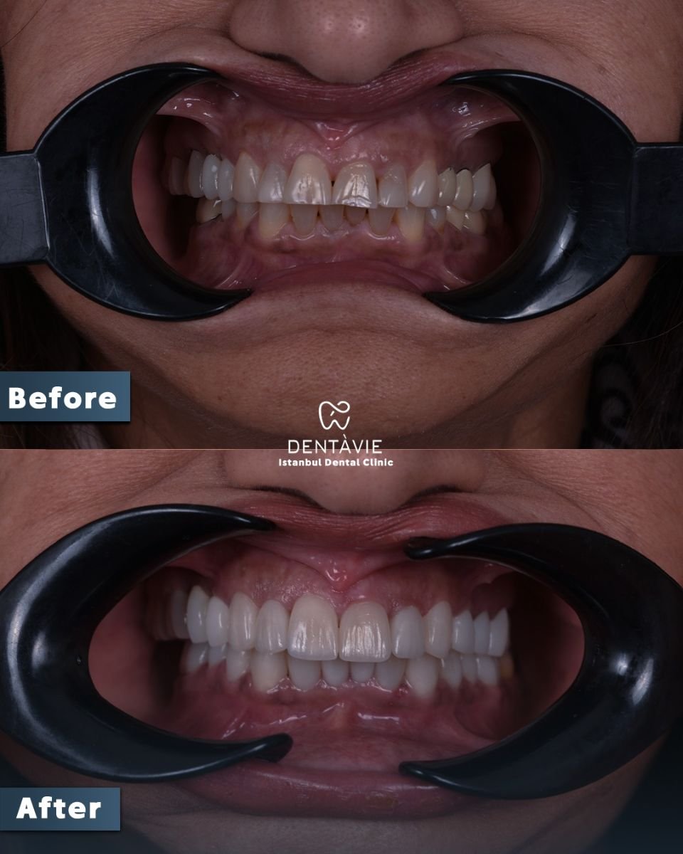 Before and after dental veneers result at Dentavie Istanbul Dental Clinic, smile transformation