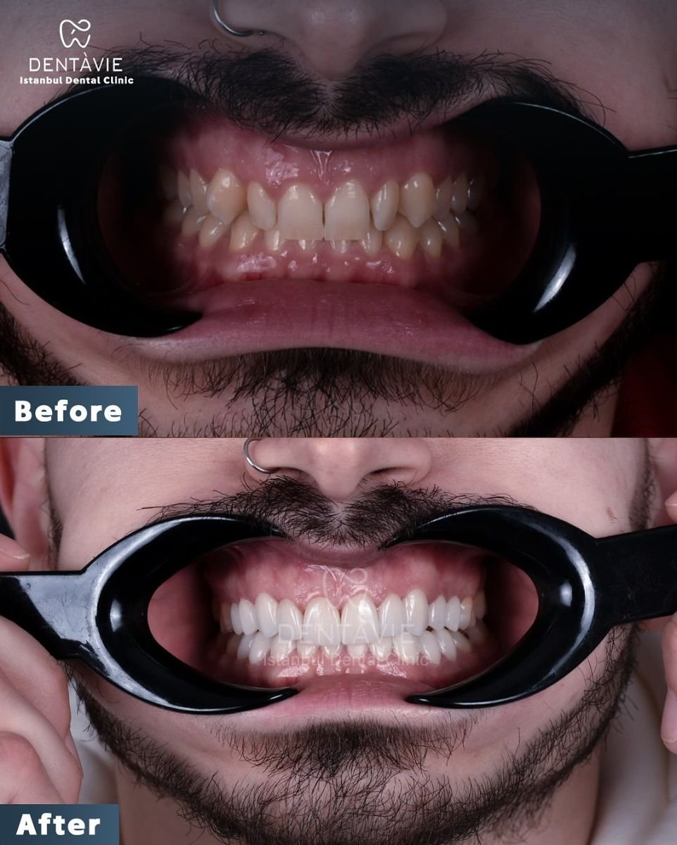 Resultados de carillas dentales antes y después en Dentavie Istanbul Dental Clinic, transformación de sonrisa
