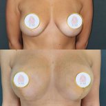 Before and after Breast augmentation photos by Dr. 