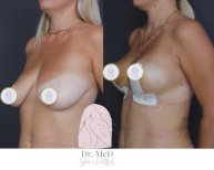 Before and after Breast augmentation photos by Dr. 
