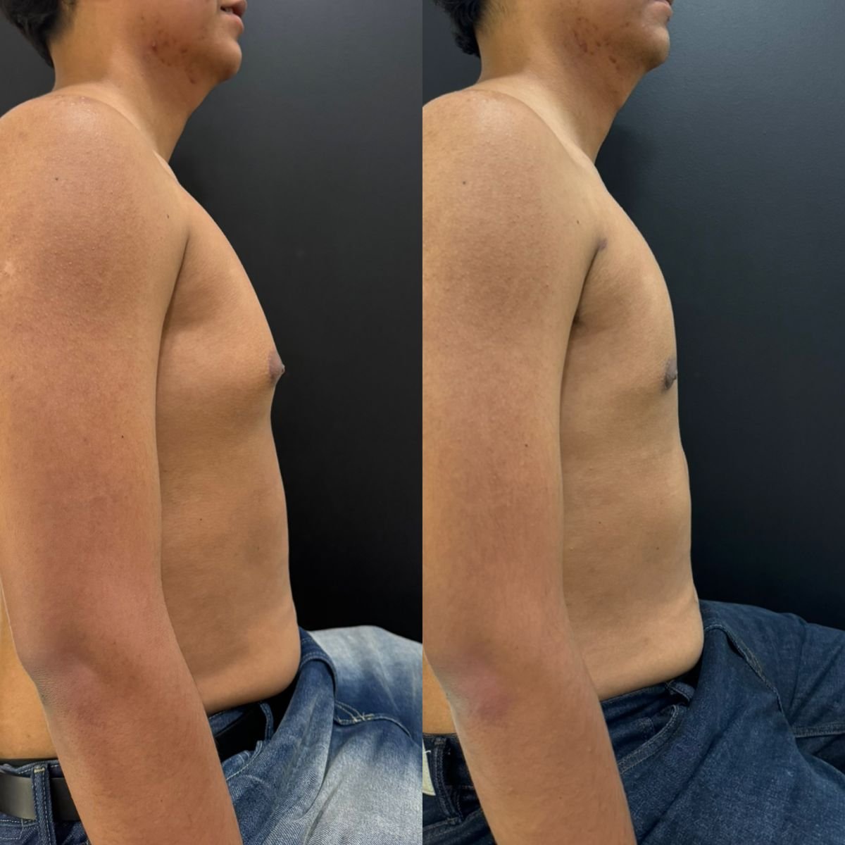 Resultados antes y después de ginecomastia en Dr. Alexandro Aguilera - Plastic Surgery