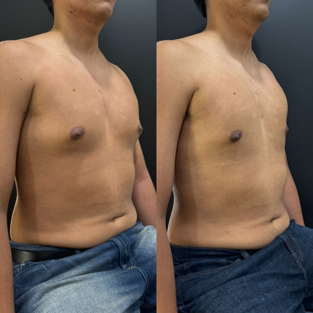 Résultats avant/après chirurgie gynécomastie chez Dr. Alexandro Aguilera - Plastic Surgery
