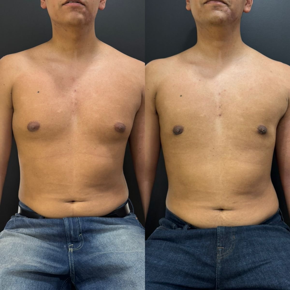 Before and after gynecomastia surgery results at Dr. Alexandro Aguilera - Plastic Surgery clinic