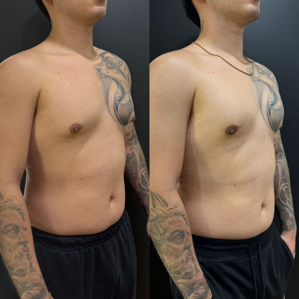 Resultados antes y después de ginecomastia en Dr. Alexandro Aguilera - Cirugía Plástica