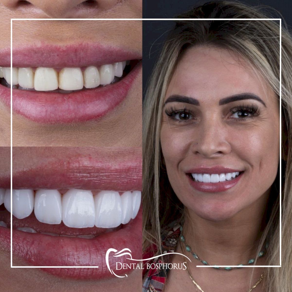 Результати до і після Hollywood Smile у Dental Bosphorus, вініри для посмішки
