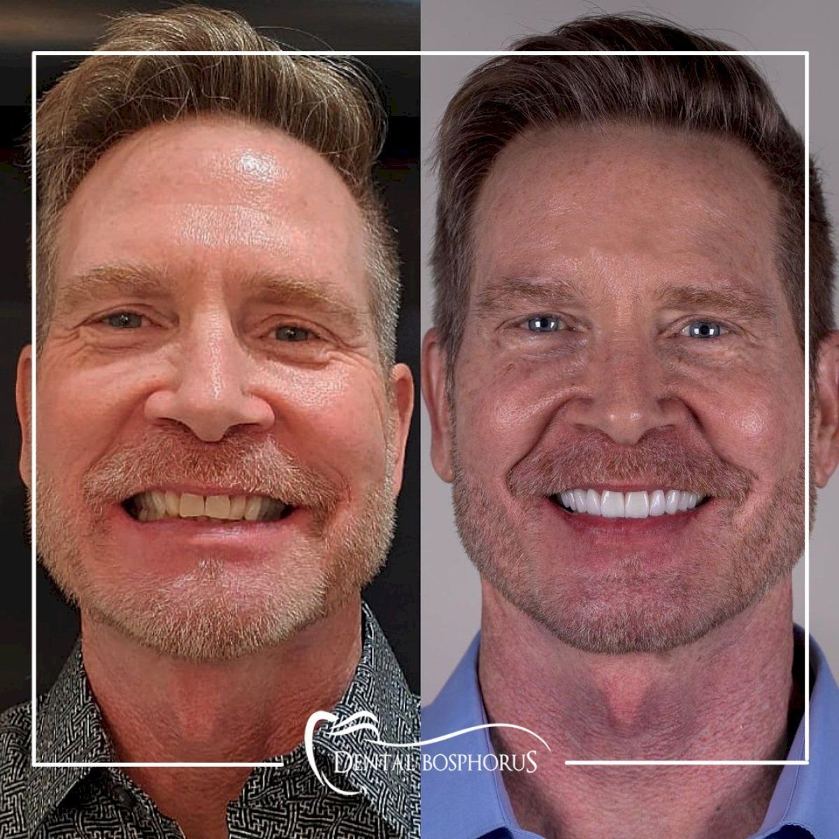 نتائج قبل وبعد ابتسامة هوليود في Dental Bosphorus، تحول ملحوظ في الابتسامة