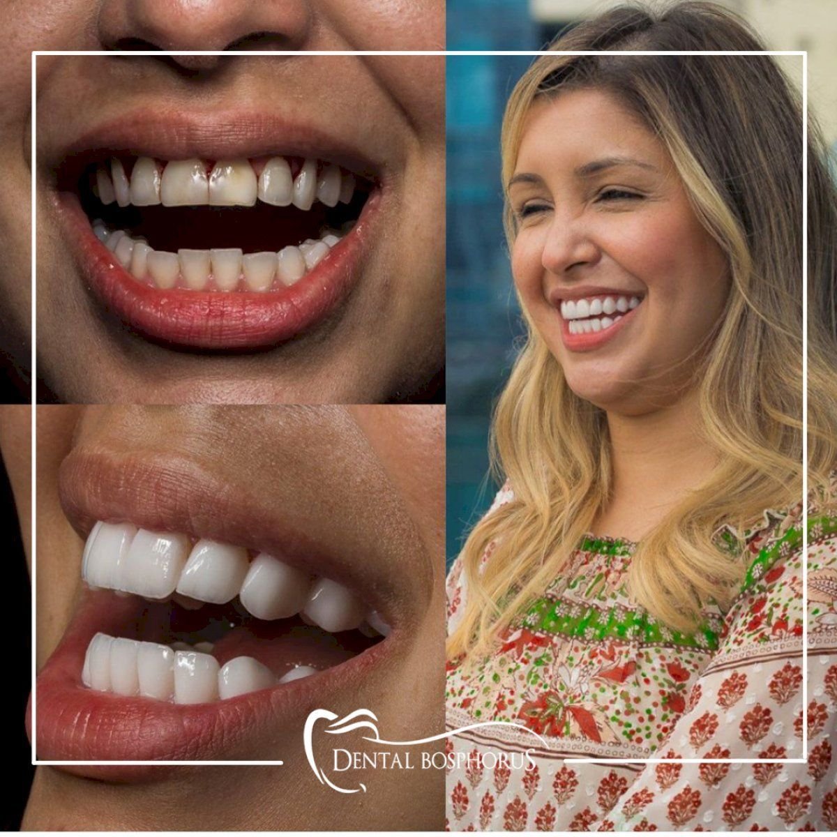 Before and after Hollywood Smile results at Dental Bosphorus, bright white veneers transformation