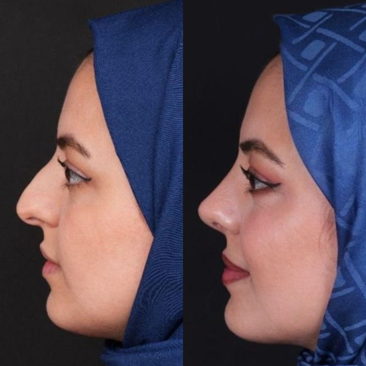 نتائج قبل وبعد تجميل طرف الأنف في مستشفى Medipol Acibadem District