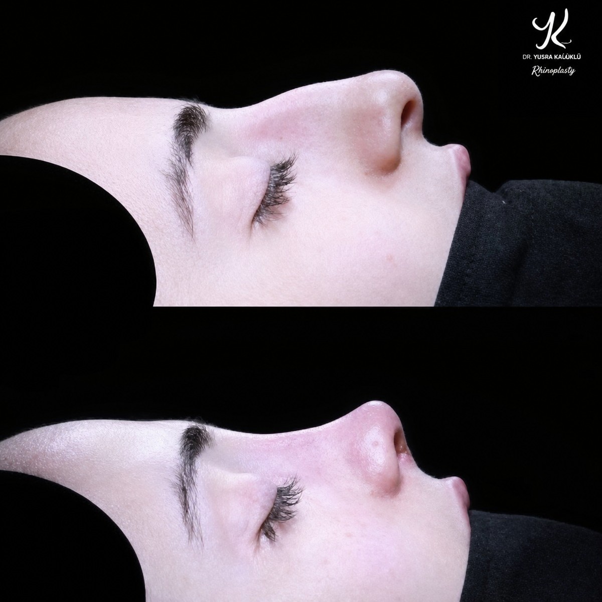 Before and after tip rhinoplasty results at Medipol Acibadem District Hospital, nose reshaping