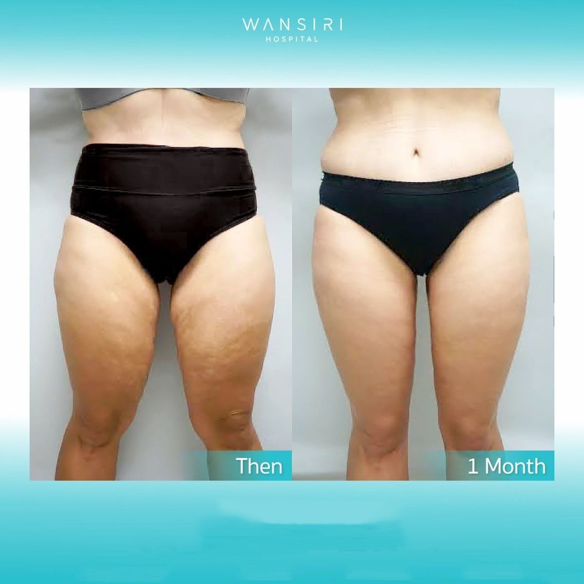 Before and after liposuction results at Wansiri Hospital, improved thigh contour in 1 month