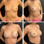 Before and after Breast augmentation photos by Dr. 