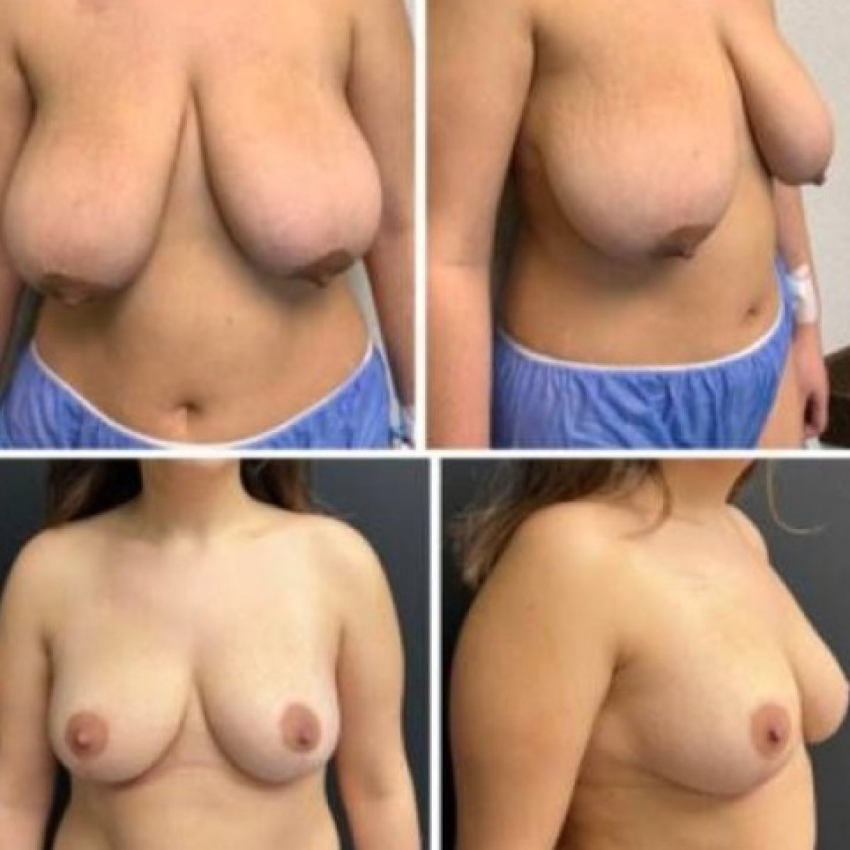 Resultados antes y después de mastopexia en Memorial Bahçelievler Hospital, mejor contorno