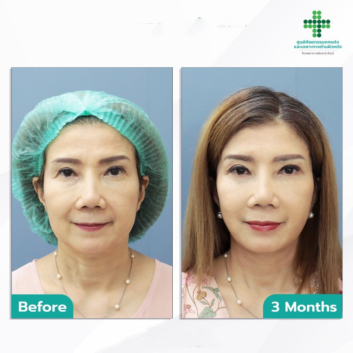 نتائج شد العيون (Fox Eye Lift) قبل وبعد في مستشفى إنترارات، رفع الجفن بعد 3 أشهر