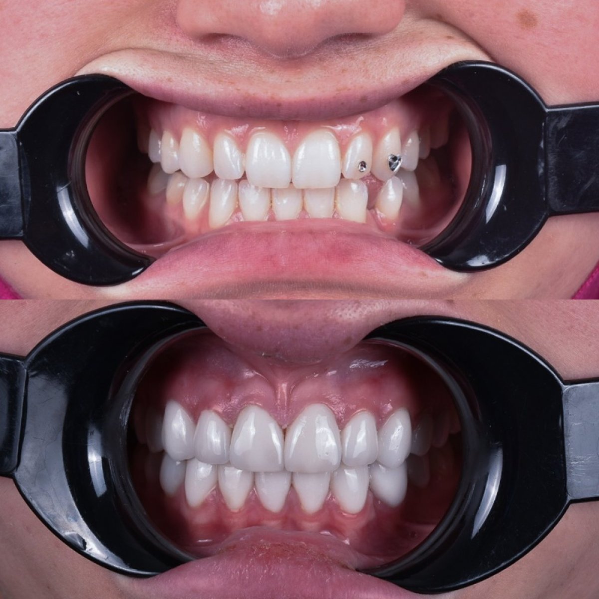 Resultado antes y después de carillas en Dentavie Istanbul Dental Clinic, cambio visible de sonrisa
