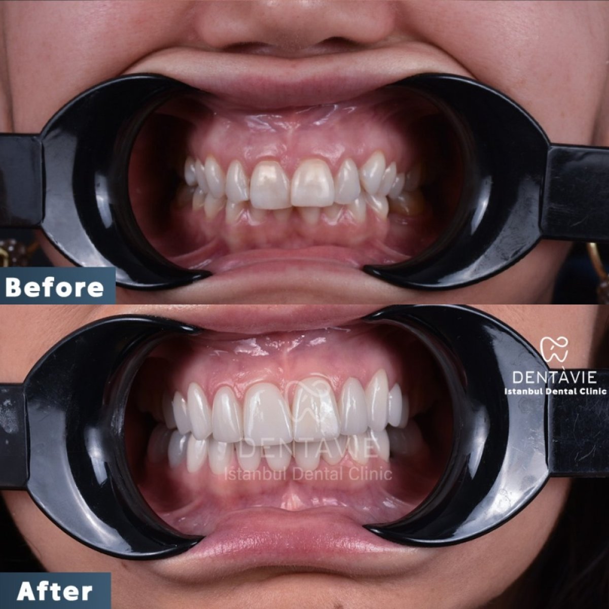Результат до и после установки виниров в Dentavie Istanbul Dental Clinic – преображение улыбки