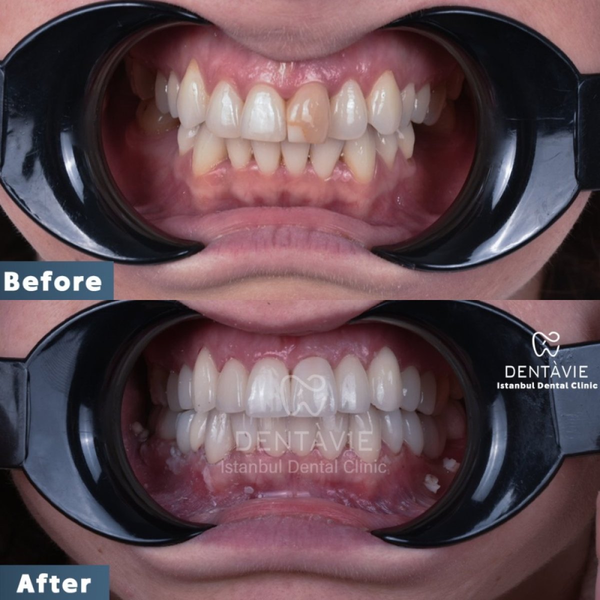 Результаты до и после установки виниров в Dentavie Istanbul Dental Clinic, преображение улыбки