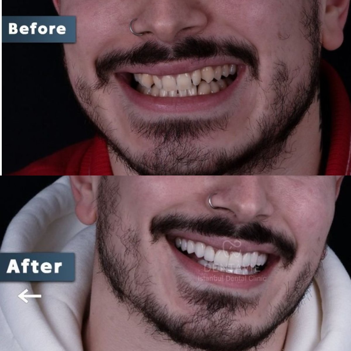 Résultat avant-après facettes dentaires à Dentavie Istanbul Dental Clinic, sourire amélioré